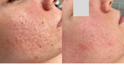 Авторский пилинг Антикомедональный 2